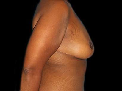 Breast Reduction Before & After Patient #2881