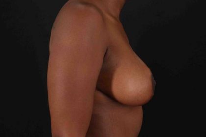 Breast Reduction Before & After Patient #2899