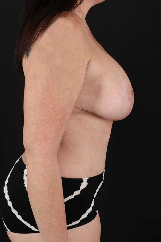All Me Augmentation Before & After Patient #2906
