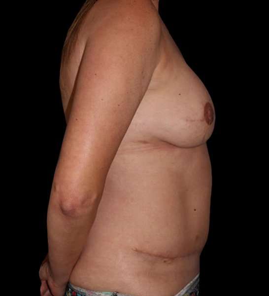 DIEP Flap Before & After Patient #2962