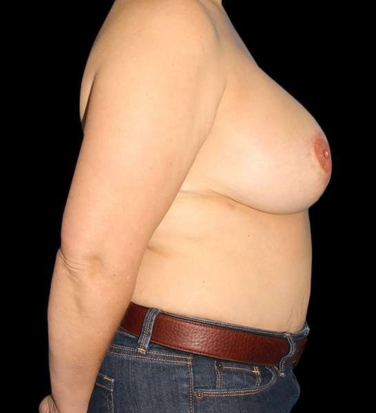 DIEP Flap Before & After Patient #2974