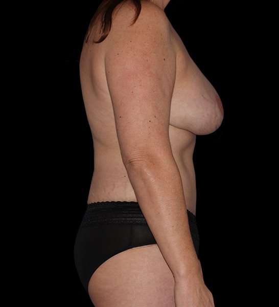 DIEP Flap Before & After Patient #2989