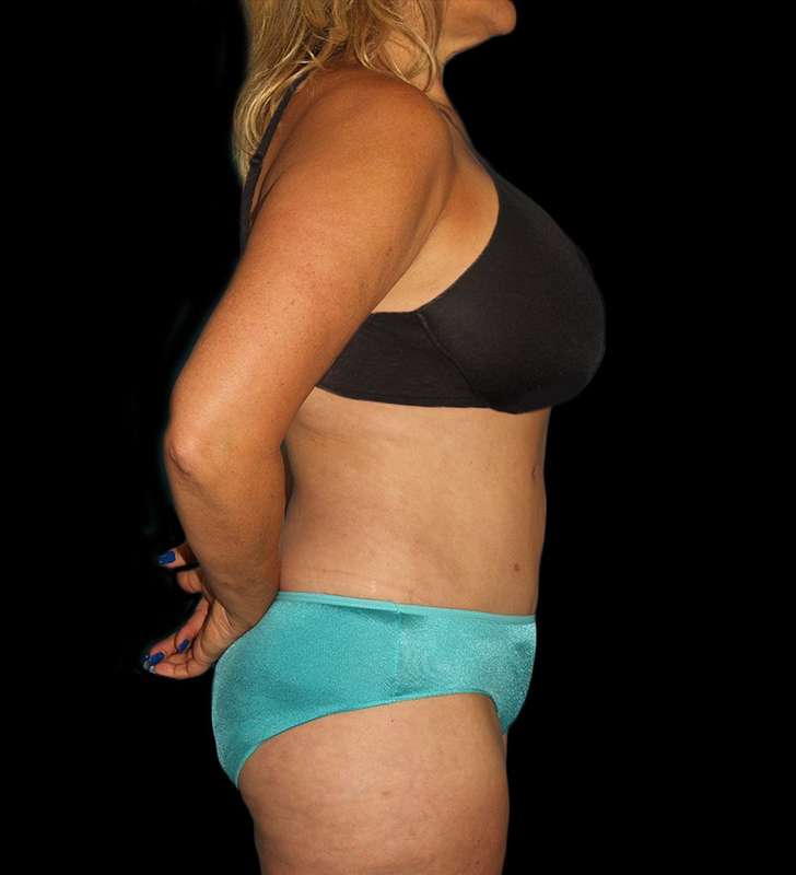 Abdominoplasty (Tummy Tuck) Before & After Patient #579