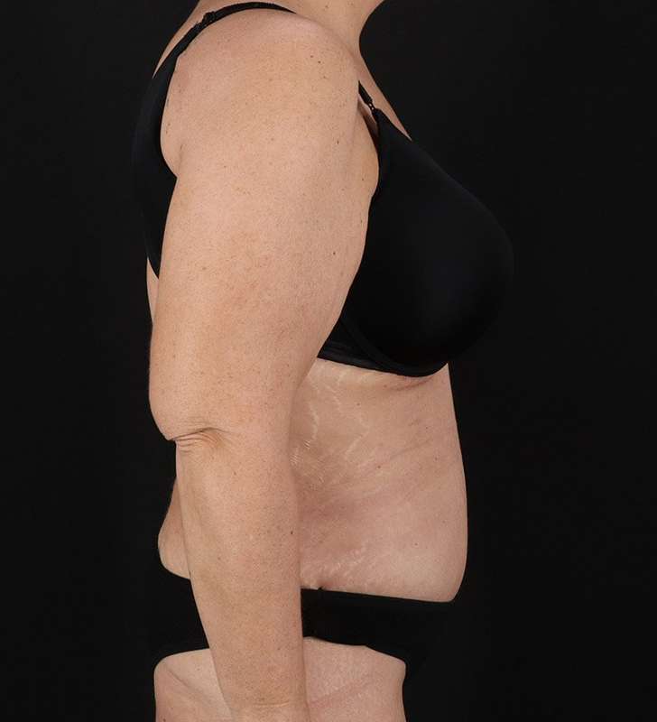 Abdominoplasty (Tummy Tuck) Before & After Patient #817