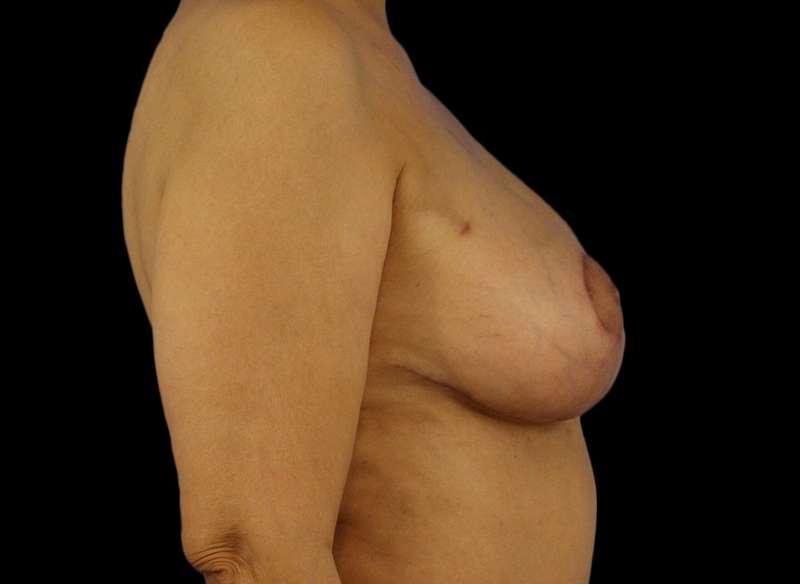 DIEP Flap Before & After Patient #3030