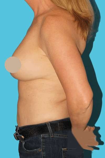 DIEP Flap Before & After Patient #3096