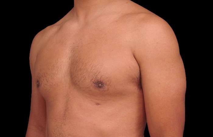 Gynecomastia Before & After Patient #3130