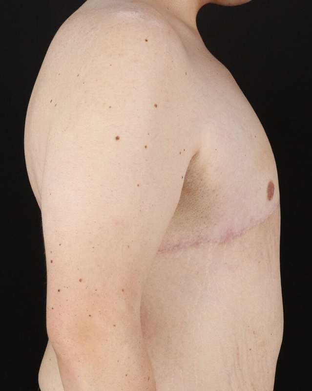 Gynecomastia Before & After Patient #3162