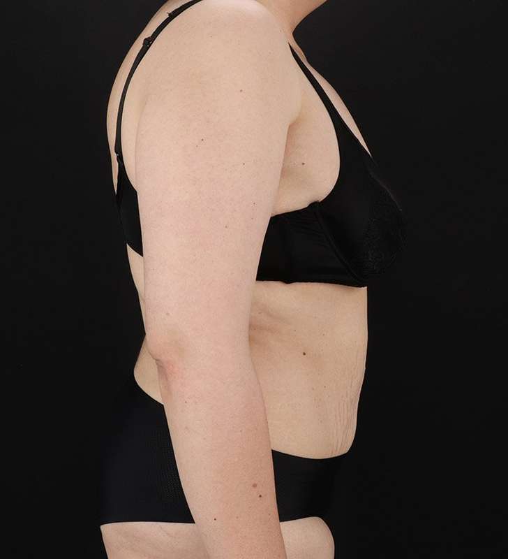 Abdominoplasty (Tummy Tuck) Before & After Patient #830