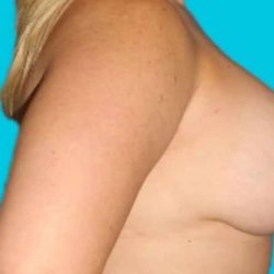 Mastopexy Before & After Patient #3251