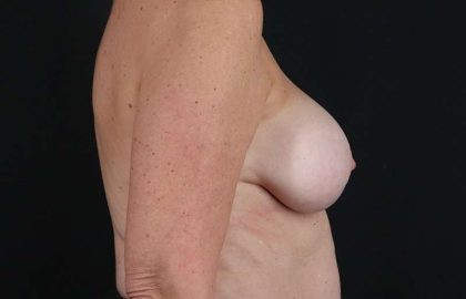 Mastopexy Before & After Patient #3290