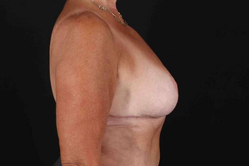 Breast Reduction With Lift Before & After Patient #3312
