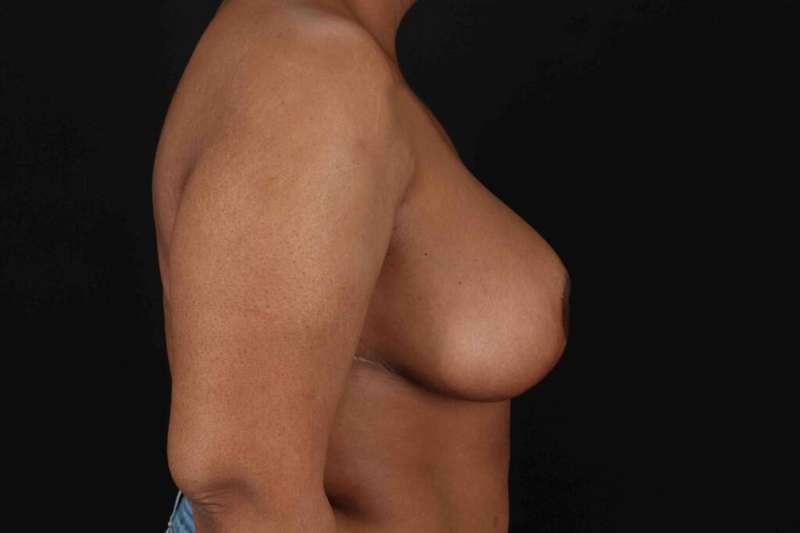 Breast Reduction With Lift Before & After Patient #3400