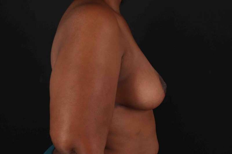 Breast Reduction With Lift Before & After Patient #3411