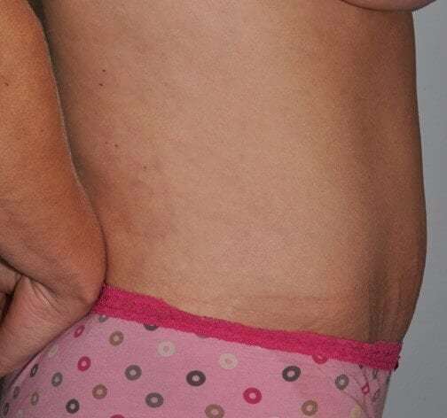 Abdominoplasty (Tummy Tuck) Before & After Patient #855