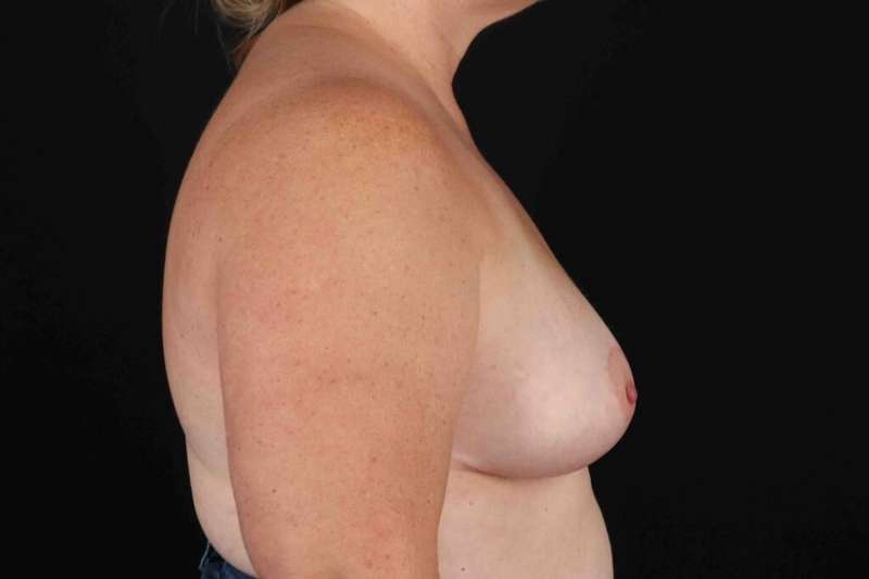 Breast Reduction With Lift Before & After Patient #3433