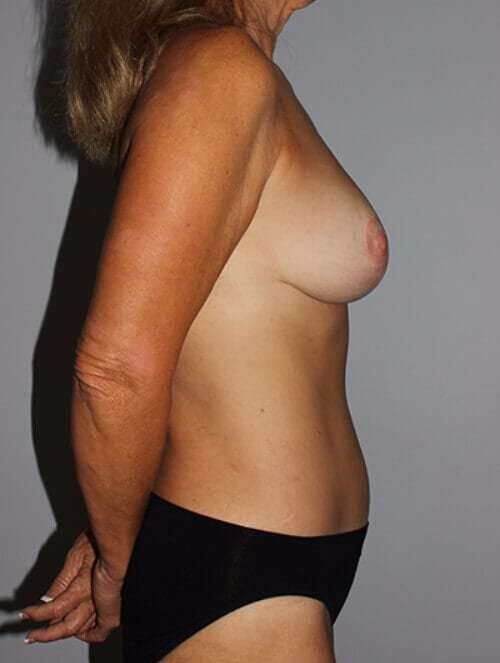 Breast Reduction With Lift Before & After Patient #3440