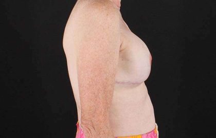 Implant Based Reconstruction Before & After Patient #3527
