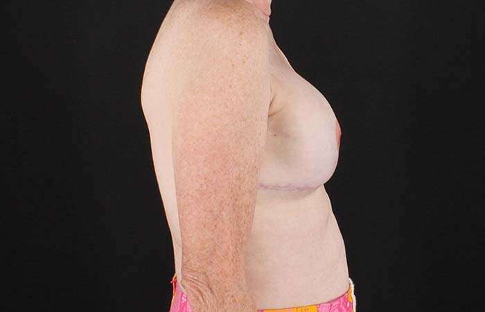 Implant Based Reconstruction Before & After Patient #3527