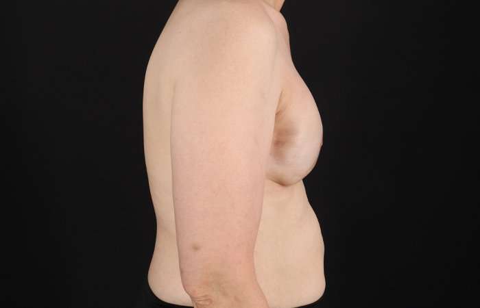 Implant Based Reconstruction Before & After Patient #3549