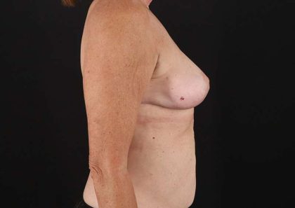 Breast Lift Before & After Patient #3582