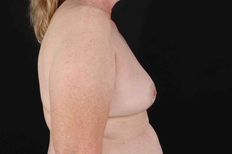 Breast Lift Before & After Patient #3593