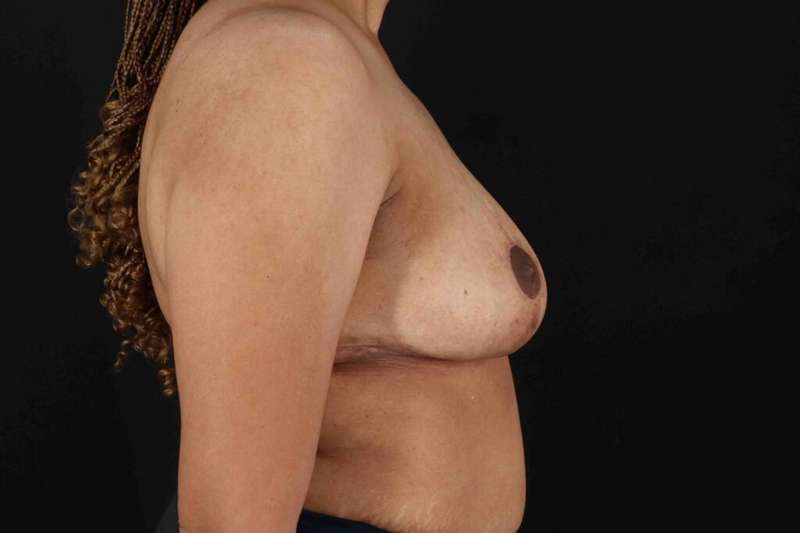 Breast Lift Before & After Patient #3626