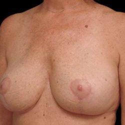 Breast Lift Before & After Patient #3633