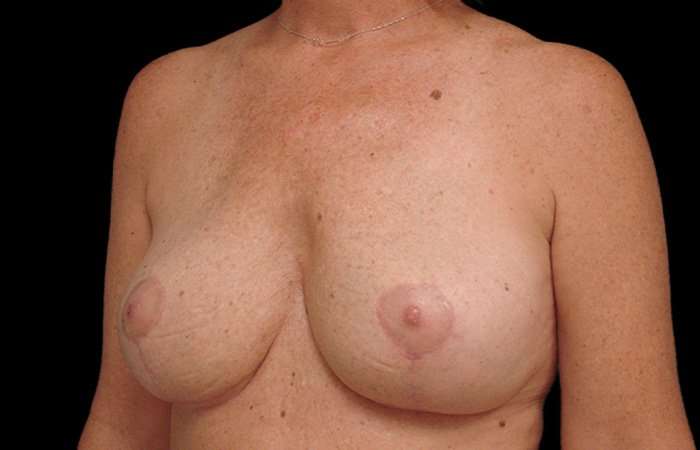 Breast Lift Before & After Patient #3633