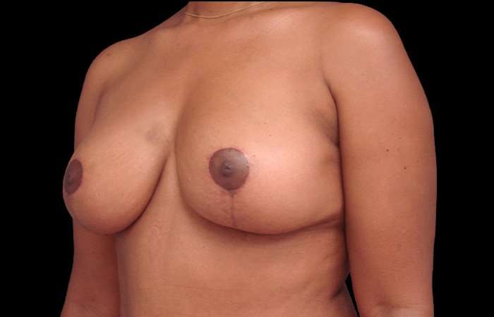 Breast Lift Before & After Patient #3640