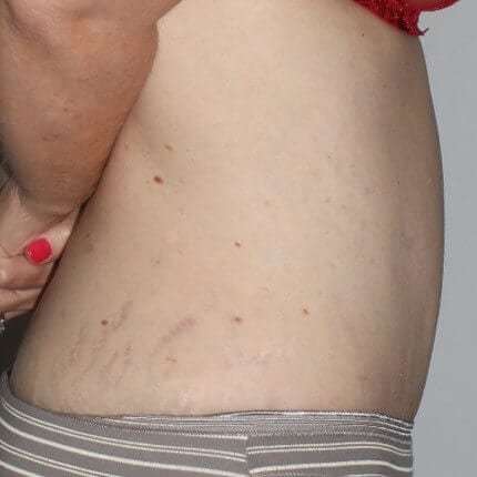 Abdominoplasty (Tummy Tuck) Before & After Patient #874