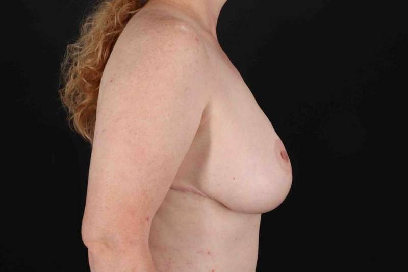 Breast Lift Before & After Patient #3684