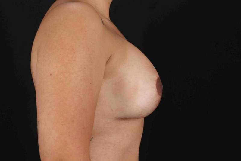 Breast Lift Before & After Patient #3717