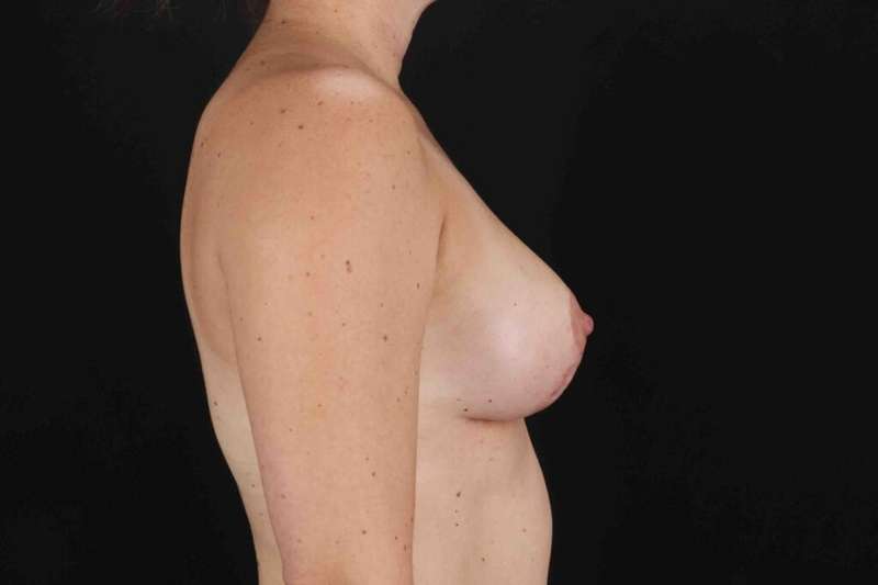Breast Lift Before & After Patient #3728