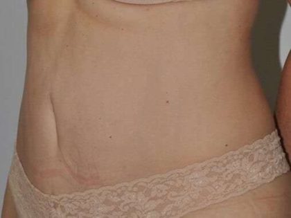 Abdominoplasty (Tummy Tuck) Before & After Patient #881