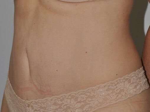 Abdominoplasty (Tummy Tuck) Before & After Patient #881