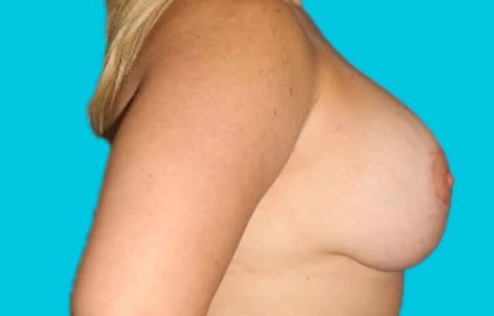 Breast Lift Before & After Patient #3779