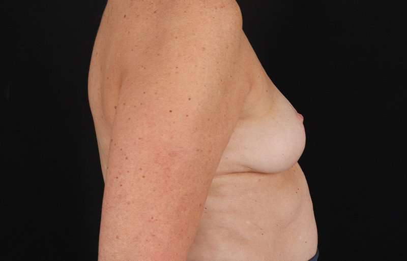 Breast Lift Before & After Patient #3864