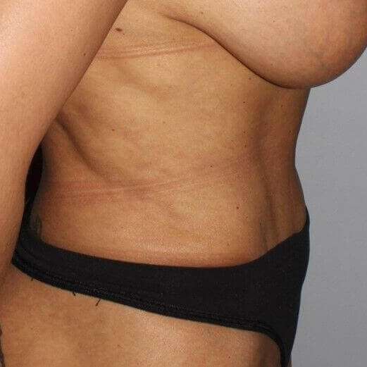 Abdominoplasty (Tummy Tuck) Before & After Patient #889