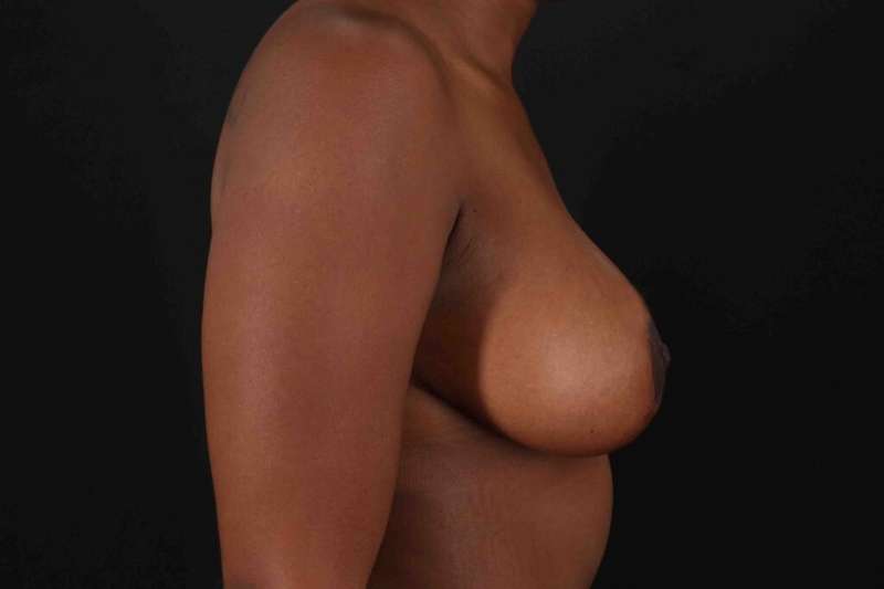 Breast Lift Before & After Patient #3875
