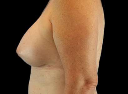 Male To Female Breast Before & After Patient #3893