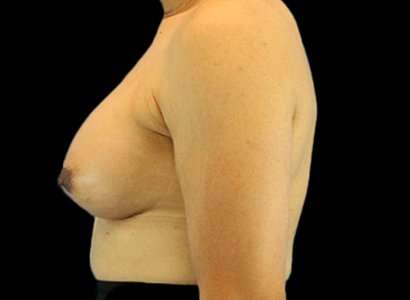Male To Female Breast Before & After Patient #3900