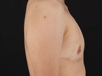Female To Male Breast Before & After Patient #3944