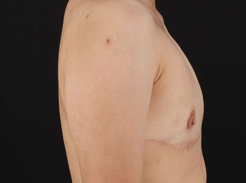 Female To Male Breast Before & After Patient #3944