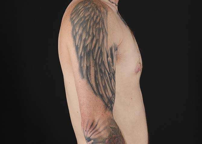 Female To Male Breast Before & After Patient #3955