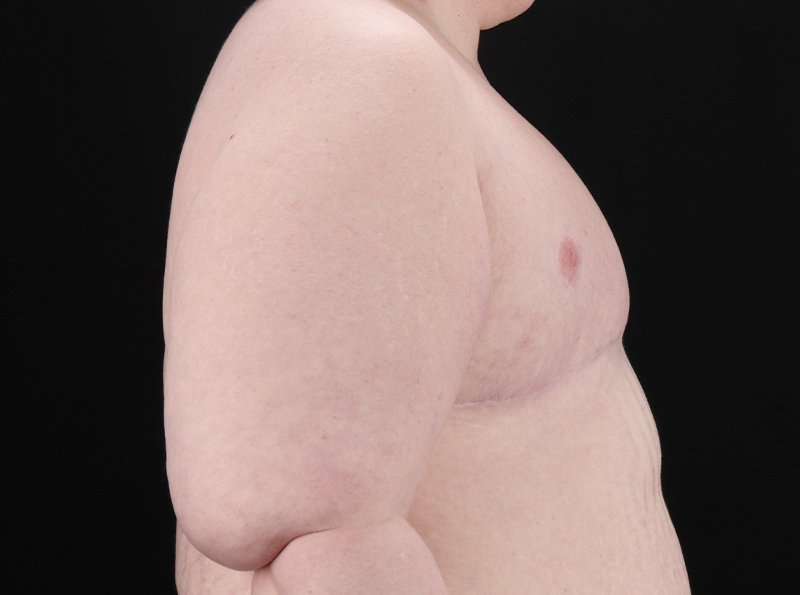 Female To Male Breast Before & After Patient #3966