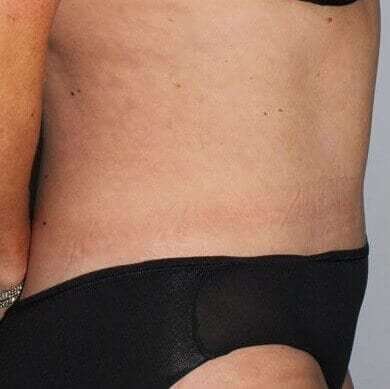 Abdominoplasty (Tummy Tuck) Before & After Patient #897