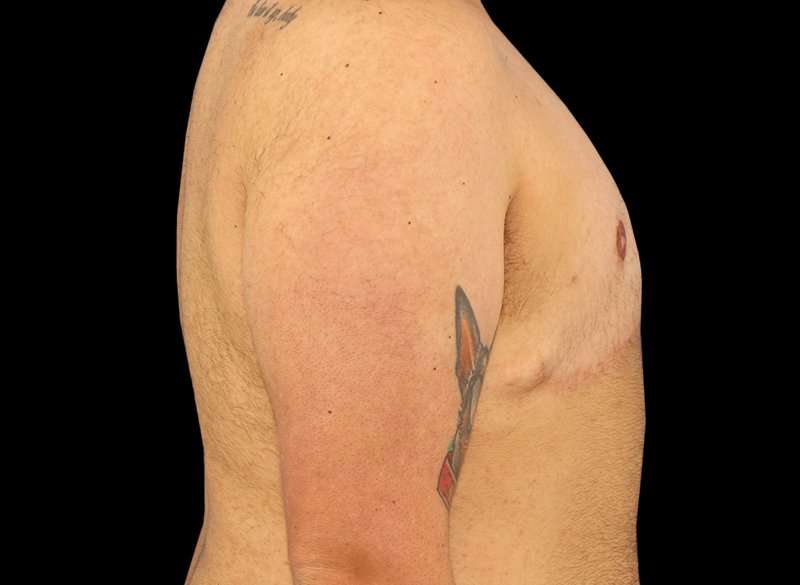 Female To Male Breast Before & After Patient #3977
