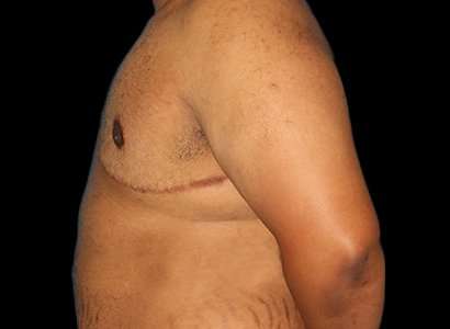 Female To Male Breast Before & After Patient #3984