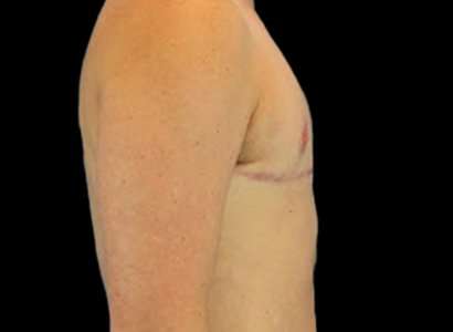 Female To Male Breast Before & After Patient #3991